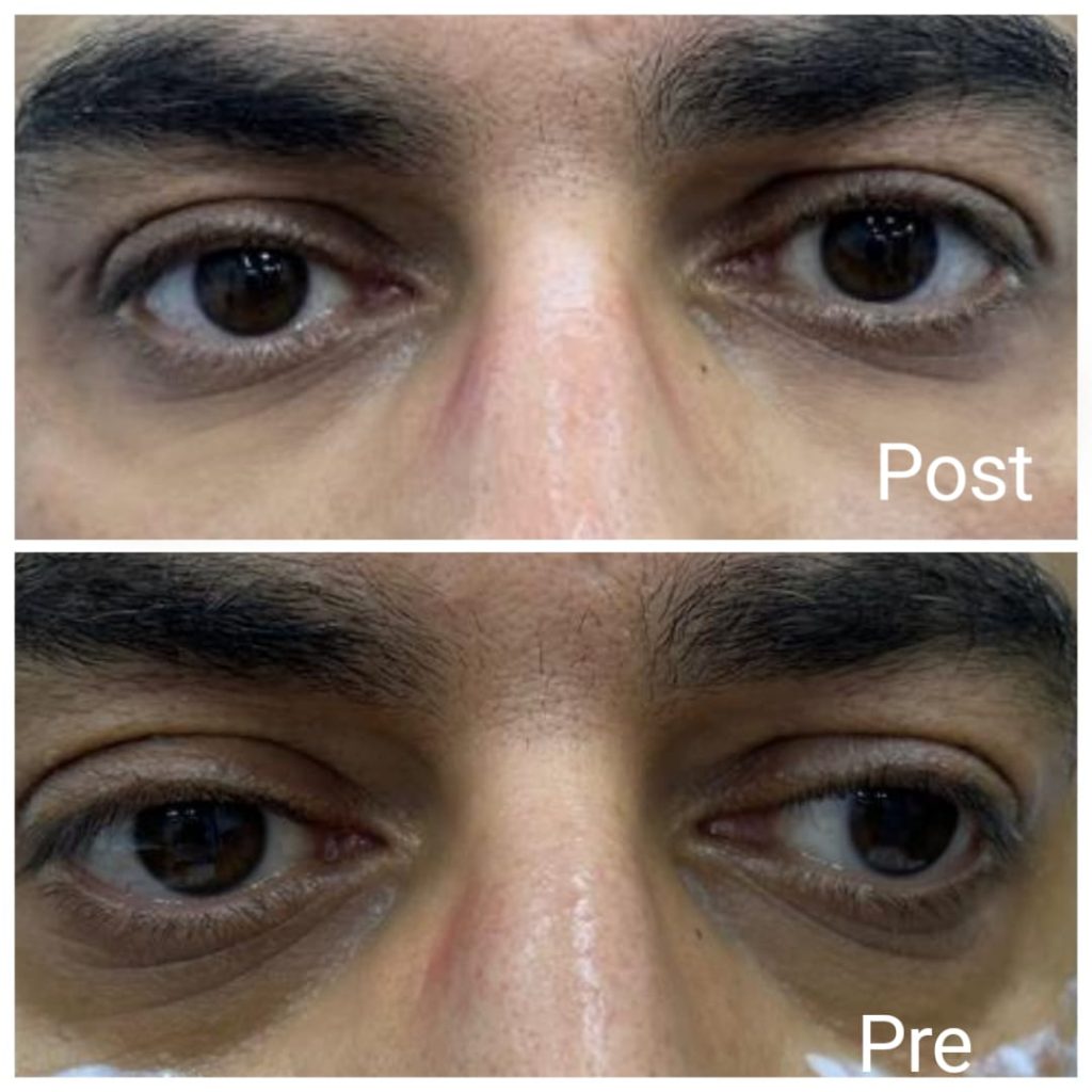 فيلر تحت العين للتجويف